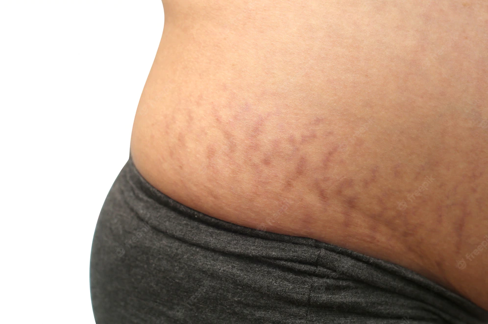 Estrias roxas são resultados de inflamação da pele em estágio mais profundo.