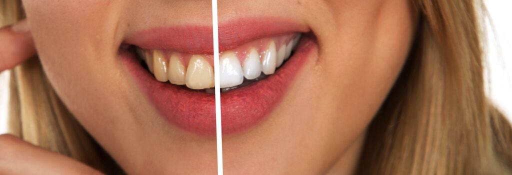Embora seja famoso, o uso de bicarbonato para clarear dentes não deve ser excessivo e frequente. Imagem: Pixabay