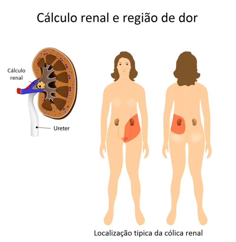 Entender como é e onde se localiza a dor da pedra nos rins ajuda a definir o diagnóstico. Imagem: Clínica Guidoni
