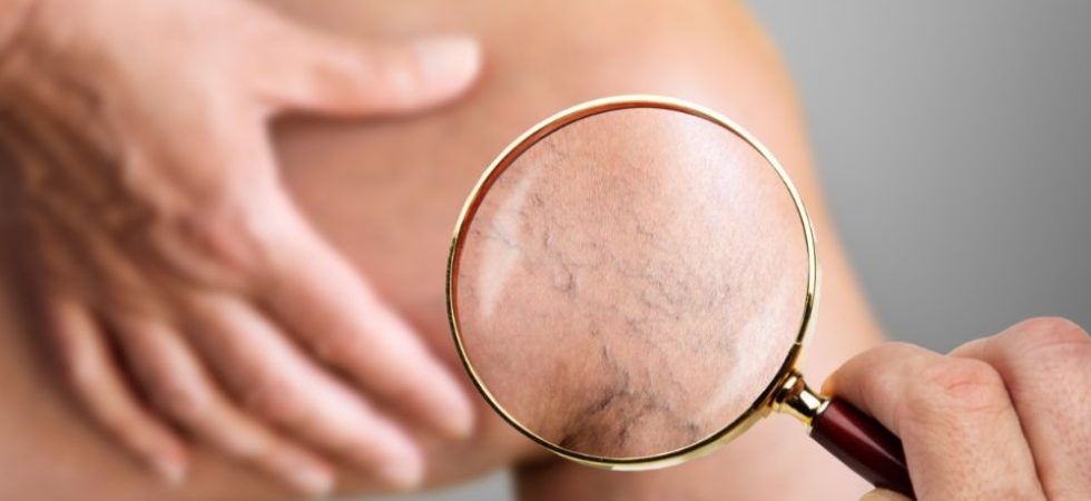 Varizes e Vasinhos Podem Ser Sinais de Alerta