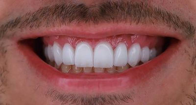 como colocar lente nos dentes