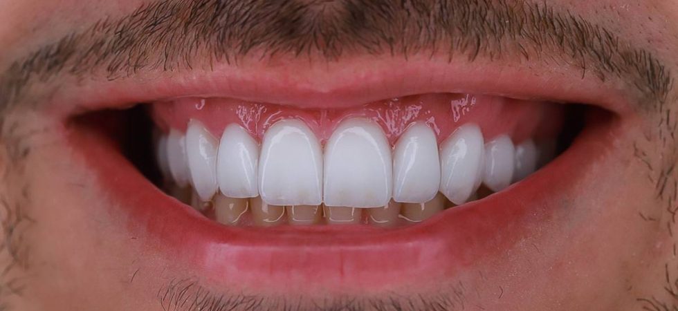como colocar lente nos dentes