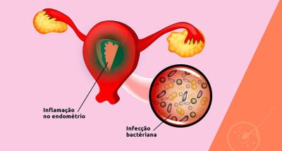 endometrite_1a