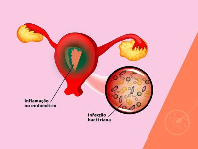 endometrite_1a