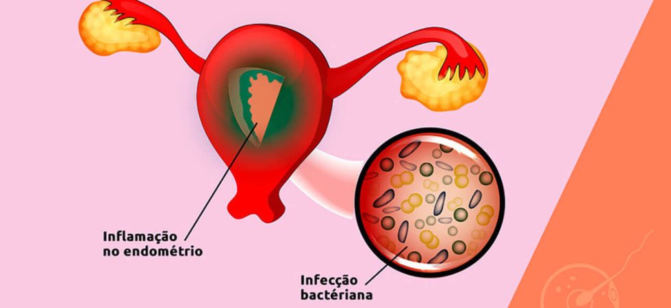 endometrite_1a